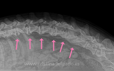 Tratamiento de hernia discal con acupuntura